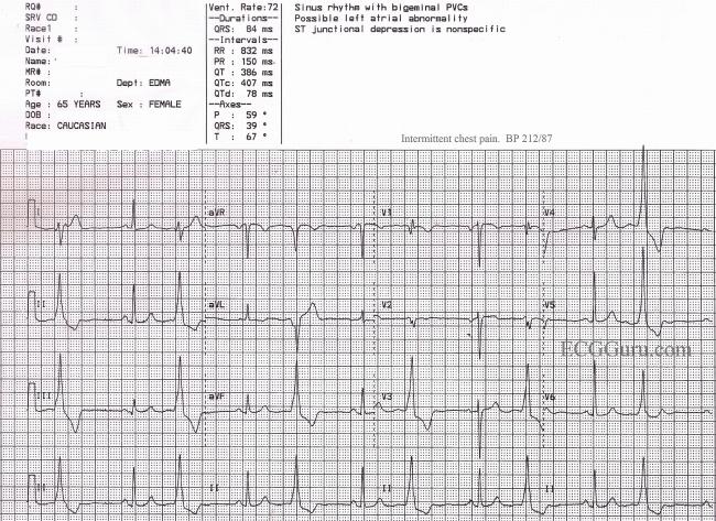 Ventricular Bigeminy Ecg Guru Instructor Resources