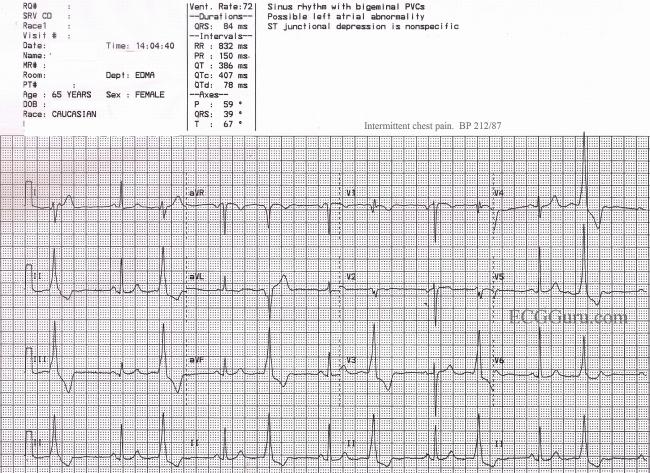 Sinus Rhythm With Ventricular Bigeminy Ecg Guru Instructor Resources