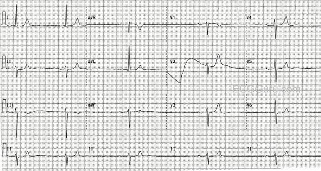 Sinus Bradycardia With First Degree Av Block And Left Anterior