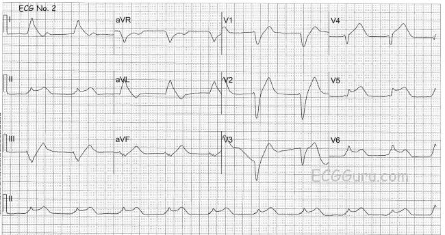 Ecg Challenge Cardiac Arrest In A 41 Year Old Woman Ecg Guru Instructor Resources