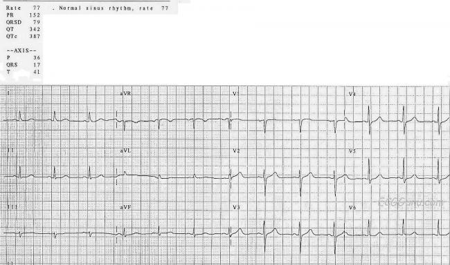 r wave progression ecg