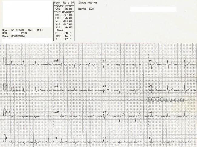 Normal Sinus Rhythm Page 2 Ecg Guru Instructor Resources Normal Sinus Rhythm Page 2 Ecg Guru Instructor Resources