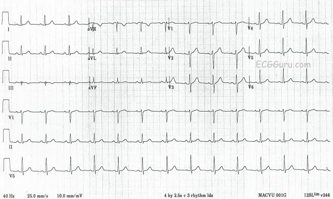 Ekg rythm strip, madison scott nide pics