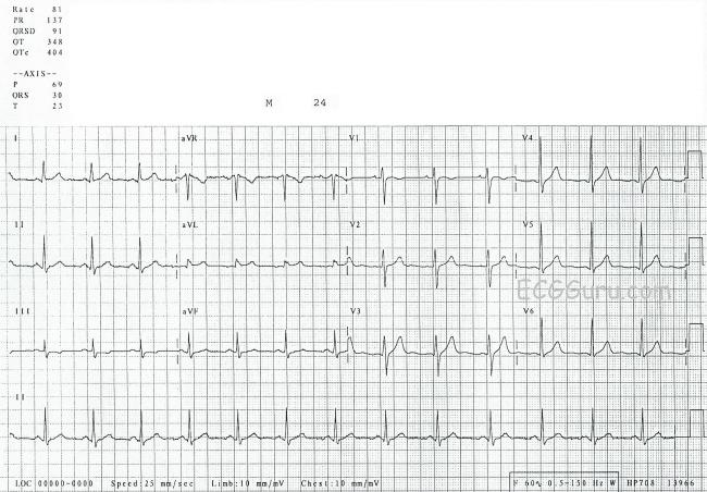 Normal Ecg In A Young Adult Ecg Guru Instructor Resources