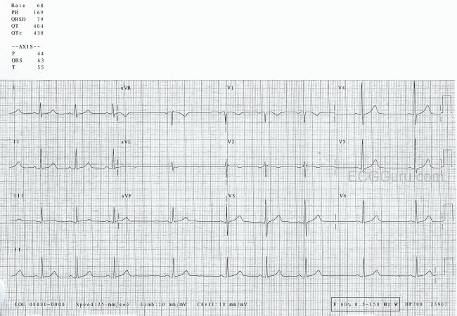 Irregular Rhythm In A Young Person Ecg Guru Instructor Resources Irregular Rhythm In A Young Person Ecg Guru Instructor Resources