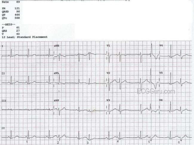 Bigeminal Rhythm With Aberrant Conduction Ecg Guru Instructor Resources