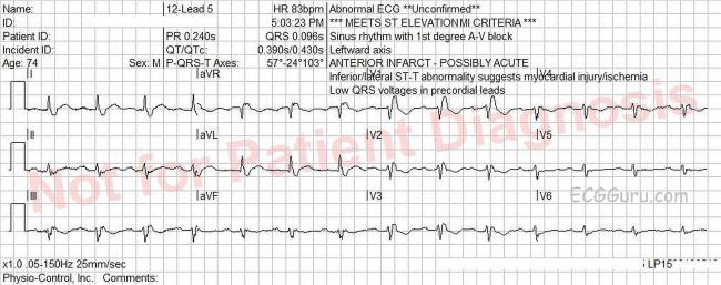 right bundle branch block with machine interpretation error rbbb ecg