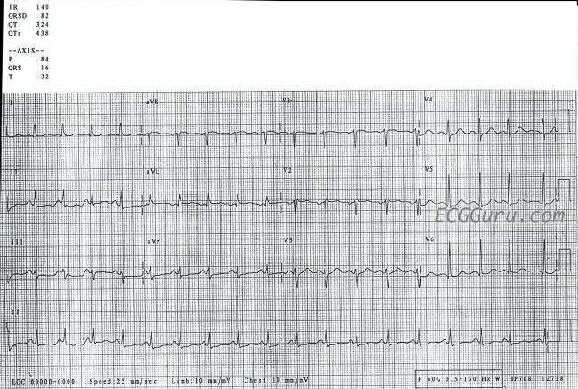 Sinus Tachycardia Ecg Guru Instructor Resources