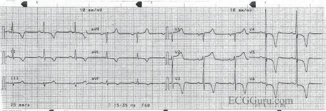 T Wave Inversion | ECG Guru - Instructor Resources