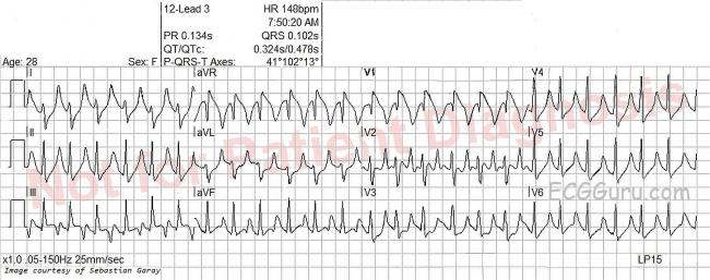 Sinus Tachycardia Ecg Guru Instructor Resources