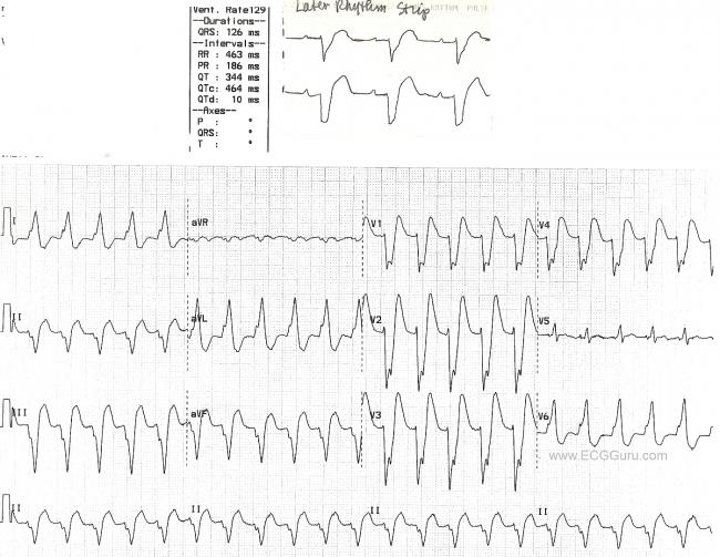 Wide Complex Tachycardia Left Bundle Branch Block With Subsequent Rhythm Strip Ecg Guru Instructor Resources Wide Complex Tachycardia Left Bundle Branch Block With Subsequent Rhythm Strip Ecg Guru Instructor Resources