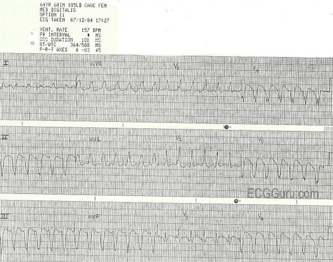 V Tach ECG Guru Instructor Resources